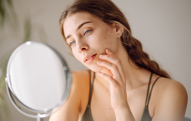 Блиц-обзор: 4 крутых бьюти-продукта, которые помогут справиться с акне