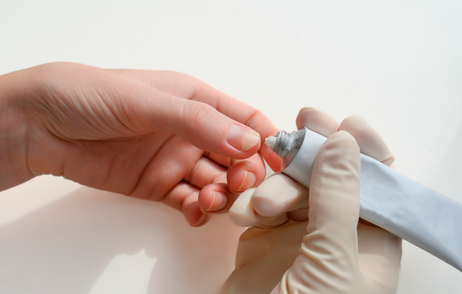 Онихолизис: почему ноготь отходит от ложа и как это исправить