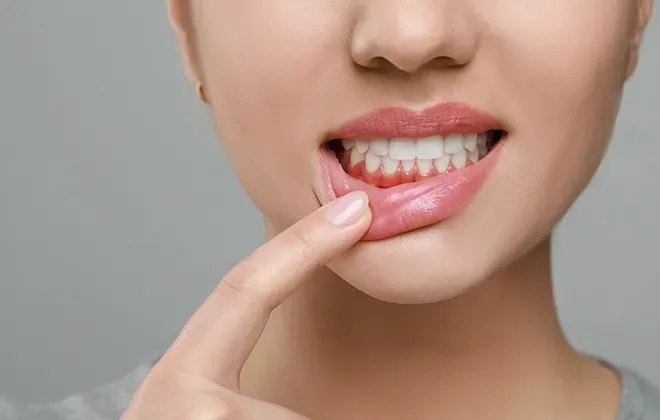 Стоматит: что это такое и как быстро вылечить воспаление во рту
