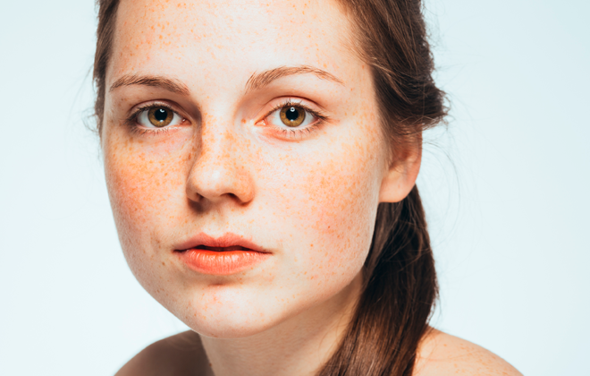 Откуда берутся веснушки и можно ли от них избавиться